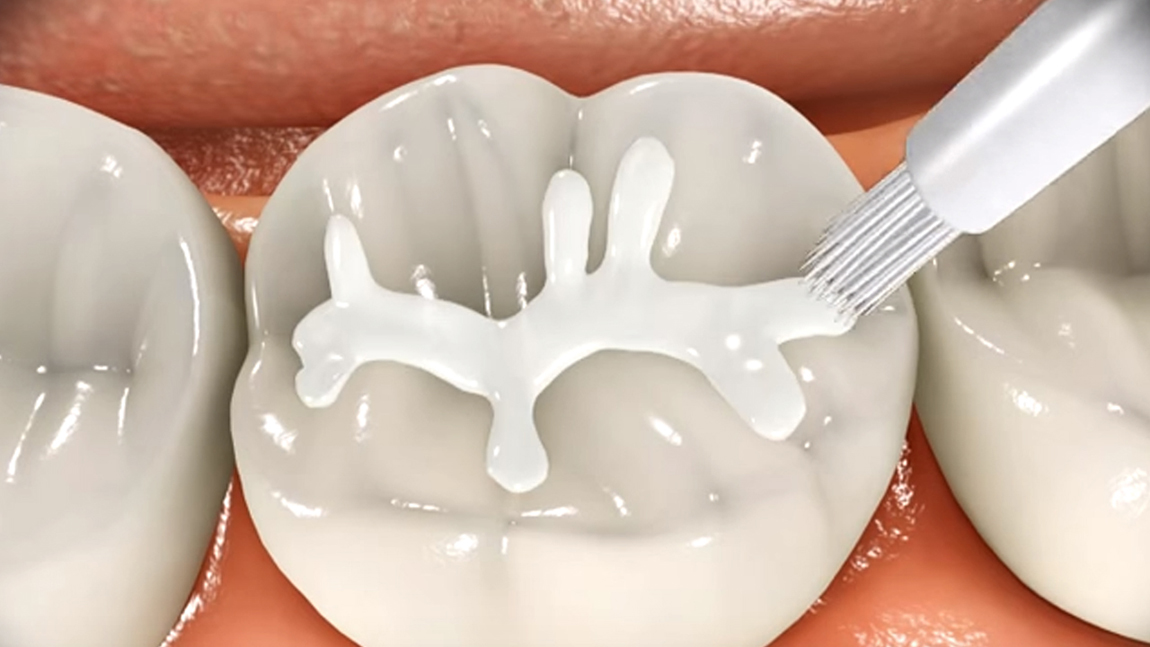 How to Prevent Dental Caries